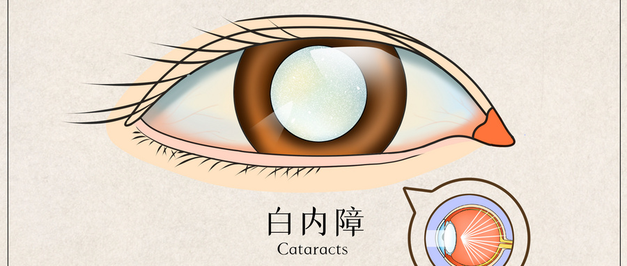 摄图网_401789645_wx_白内障医疗插画（企业商用）.jpg